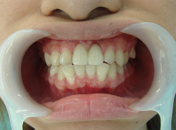 オールセラミッククラウン（e-max）の症例写真 歯が無いように見えてしまう,After,ba_ceramic49_a01.jpg