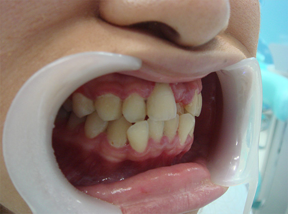 症例写真,オールセラミッククラウン（e-max）　歯のエステも施行,Before,ba_ceramic50_b.jpg