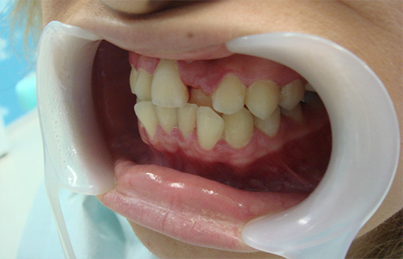 症例写真,オールセラミッククラウン（e-max）　歯のエステも施行,Before,ba_ceramic51_b.jpg
