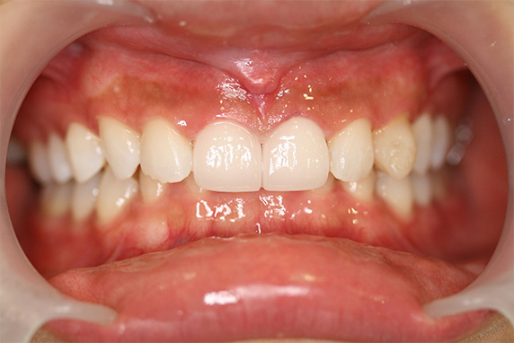 症例写真,ラミネートベニアの症例 上の前歯2本が中に入っているのが気になる,After,ba_laminated_veneer01_b.jpg