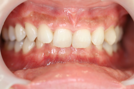 症例写真,ラミネートベニアの症例 上の前歯2本が中に入っているのが気になる,Before,ba_laminated_veneer01_b.jpg