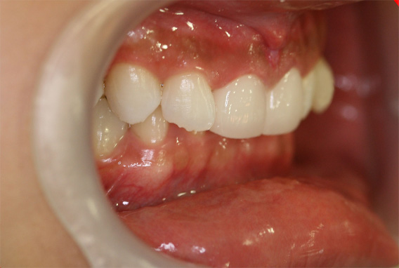 症例写真,ラミネートベニアの症例 上の前歯2本が中に入っているのが気になる,After,ba_laminated_veneer02_b.jpg