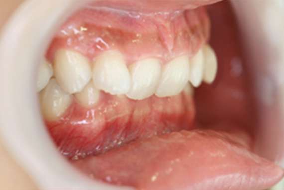 症例写真,ラミネートベニアの症例 上の前歯2本が中に入っているのが気になる,Before,ba_laminated_veneer02_b.jpg