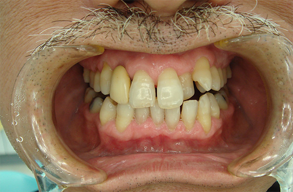 症例写真,歯のエステの症例写真,After,ba_esthe01_b.jpg
