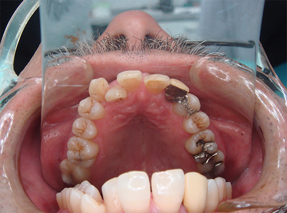 症例写真,歯のエステ,After,ba_esthe02_b.jpg