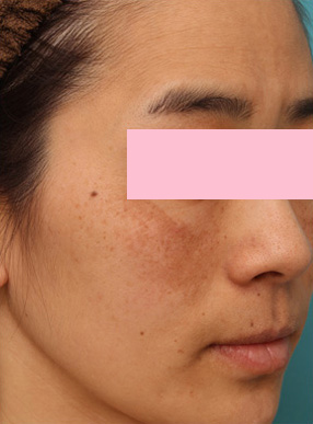 症例写真,レーザートーニング(肝斑モード)の症例写真,Before,ba_alextrivantage04_b.jpg