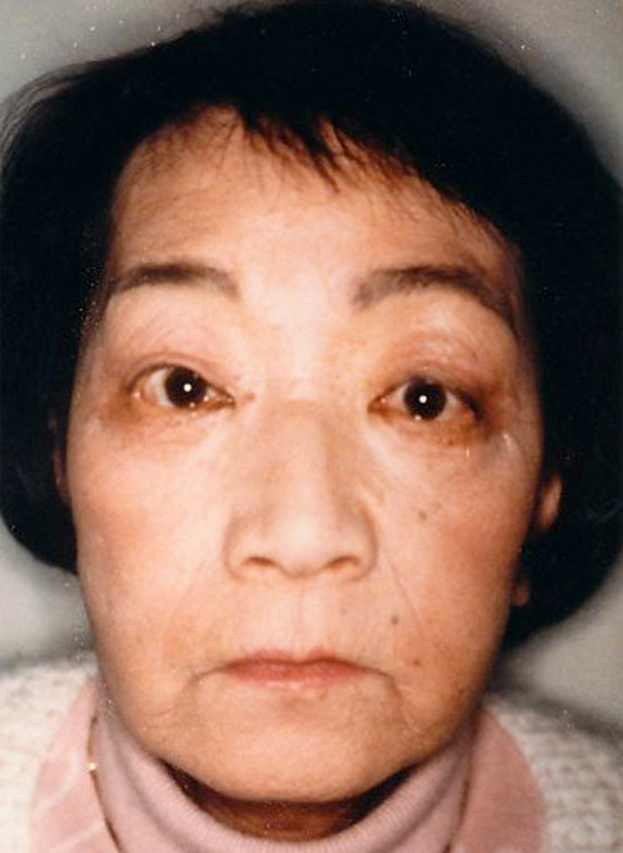 症例写真,フルフェイスリフトの症例写真　額リフト（額のしわ取り手術）も施行,After,ba_facelift_pic07_b.jpg