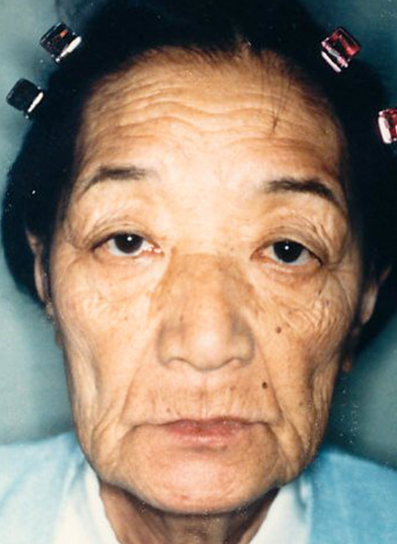 症例写真,フルフェイスリフトの症例写真　額リフト（額のしわ取り手術）も施行,Before,ba_facelift_pic07_b.jpg