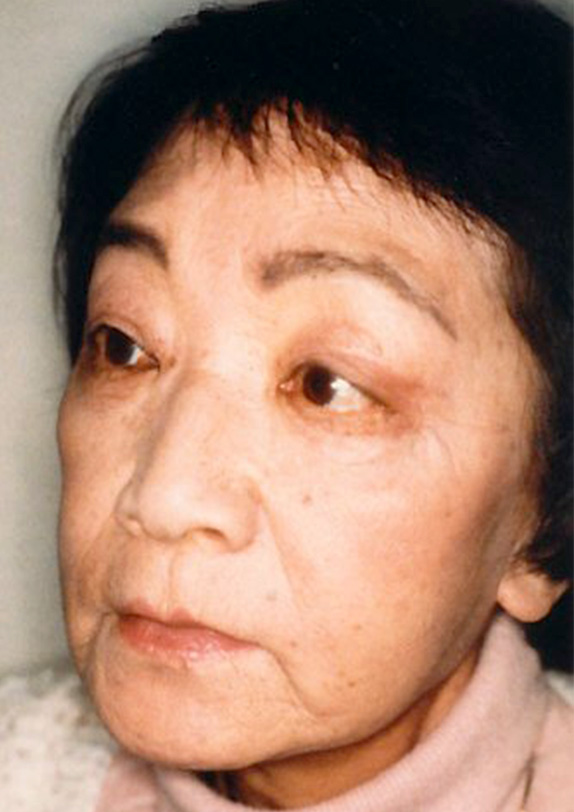 フルフェイスリフト,フルフェイスリフトの症例写真　額リフト（額のしわ取り手術）も施行,After,ba_facelift_pic08_b.jpg