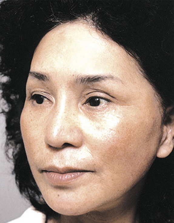 フルフェイスリフト,フルフェイスリフトを行った82歳女性の症例写真,After,ba_facelift_pic13_b.jpg