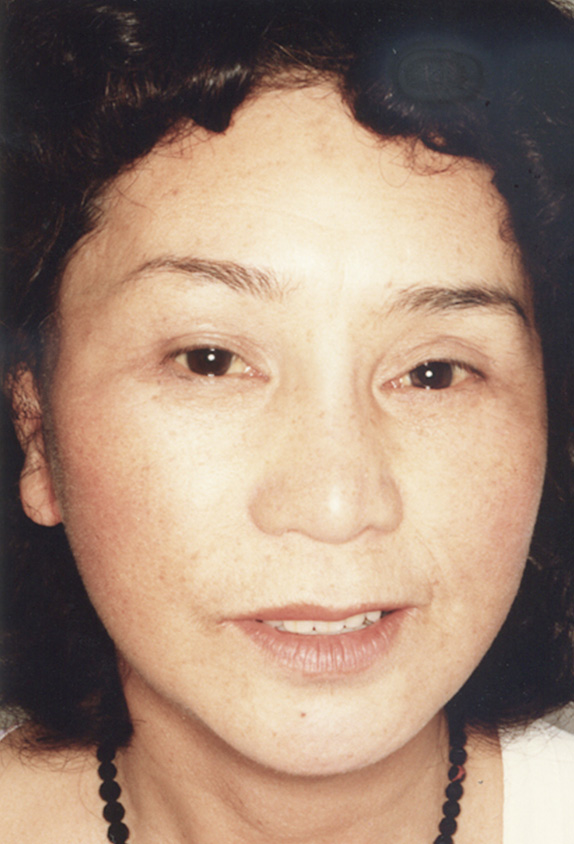 フルフェイスリフトを行った82歳女性の症例写真,After,ba_facelift_pic14_a01.jpg