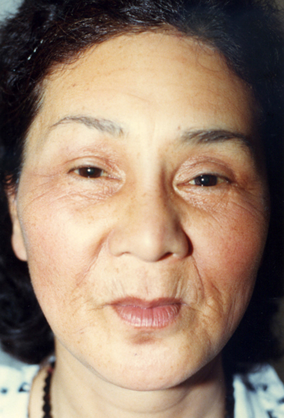 額リフト（額のしわ取り手術）,フルフェイスリフトを行った82歳女性の症例写真,Before,ba_facelift_pic14_b.jpg