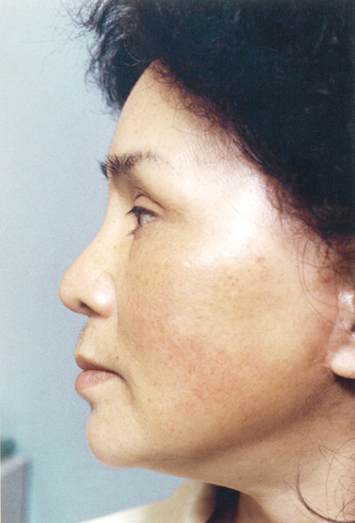 フルフェイスリフト,フルフェイスリフトを行った82歳女性の症例写真,After,ba_facelift_pic15_b.jpg