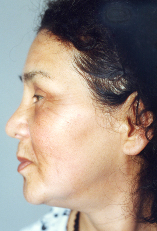 症例写真,フルフェイスリフトを行った82歳女性の症例写真,Before,ba_facelift_pic15_b.jpg