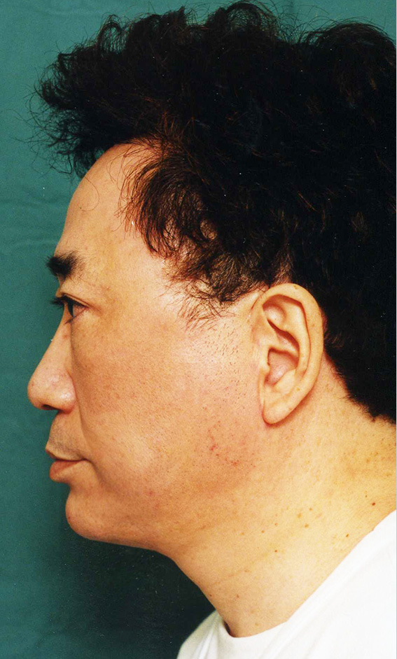 症例写真,高須クリニック院長高須克弥のフルフェイスリフト症例写真,After（6ヶ月後）,ba_facelift_pic12_b.jpg