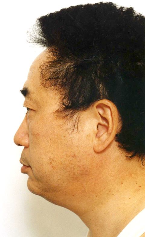 症例写真,高須クリニック院長高須克弥のフルフェイスリフト症例写真,施術前,mainpic_facelift01a.jpg