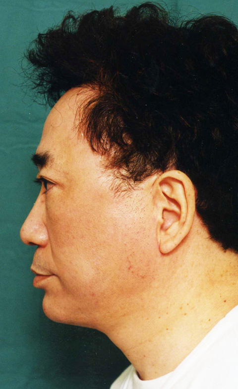 症例写真,高須クリニック院長高須克弥のフルフェイスリフト症例写真,6ヶ月後,mainpic_facelift01c.jpg