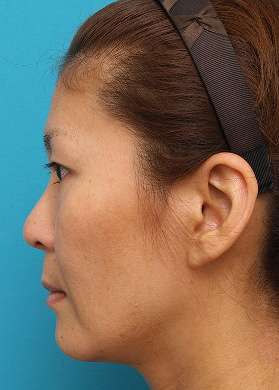 症例写真,ミディアムフェイスリフトの症例 顔のたるみを除去した女性,Before,ba_mediumlift_pic05_b.jpg