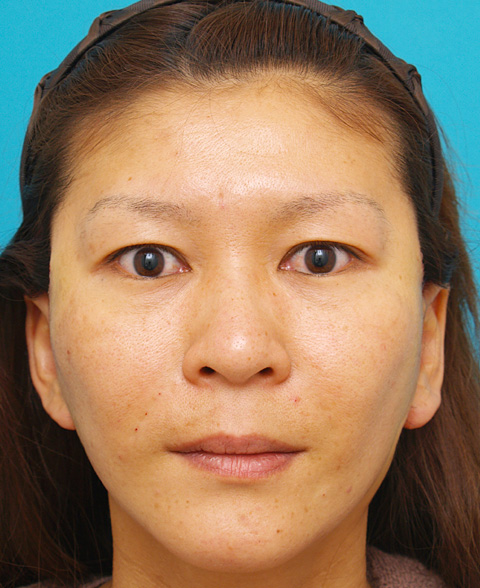 症例写真,ミディアムフェイスリフトの症例 顔のたるみを除去した女性,施術直後,mainpic_mediumlift01b.jpg