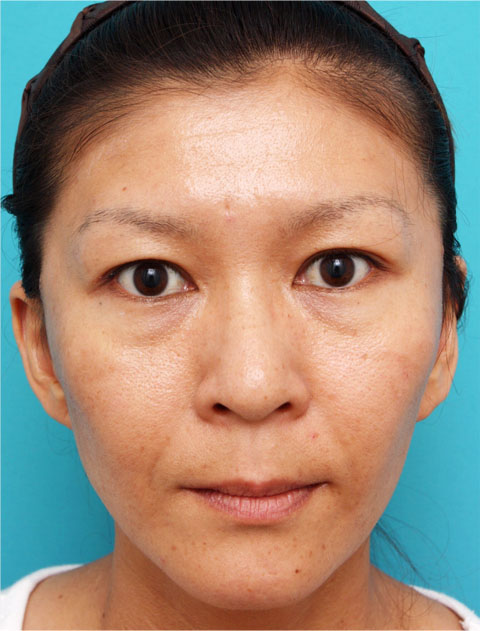 症例写真,ミディアムフェイスリフトの症例 顔のたるみを除去した女性,3ヶ月後,mainpic_mediumlift01c.jpg