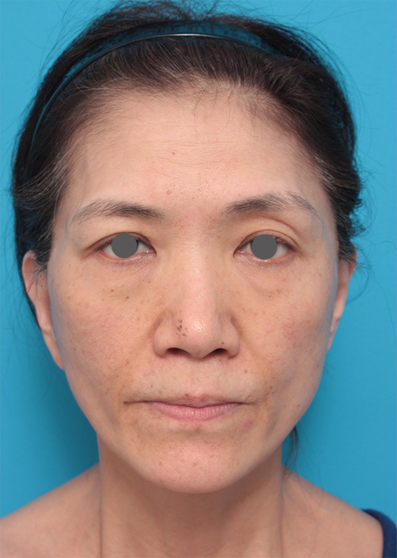 症例写真,50代女性に行ったミディアムフェイスリフト症例写真,After（2ヶ月後）,ba_mediumlift_pic09_b.jpg