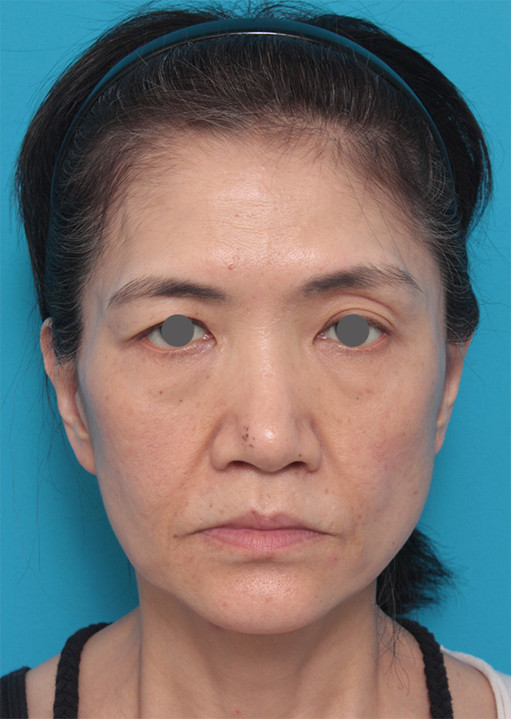 症例写真,50代女性に行ったミディアムフェイスリフト症例写真,Before,ba_mediumlift_pic09_b.jpg