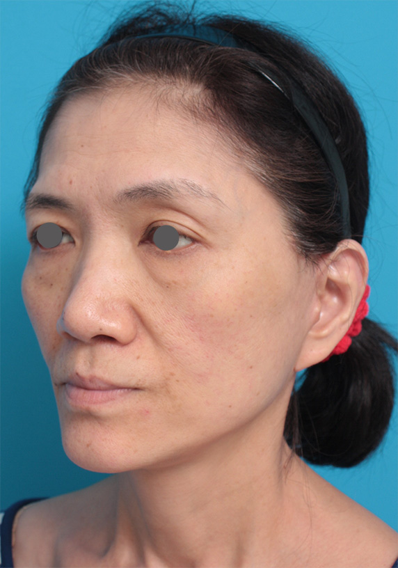 症例写真,50代女性に行ったミディアムフェイスリフト症例写真,After(2ヶ月後),ba_mediumlift_pic10_b.jpg
