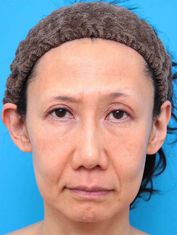 40代女性のミディアムフェイスリフト症例写真,Before,ba_mediumlift12_b.jpg