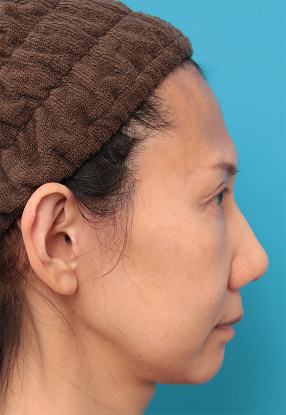 症例写真,40代女性のミディアムフェイスリフト症例写真,After（6ヶ月後）,ba_mediumlift14_b.jpg