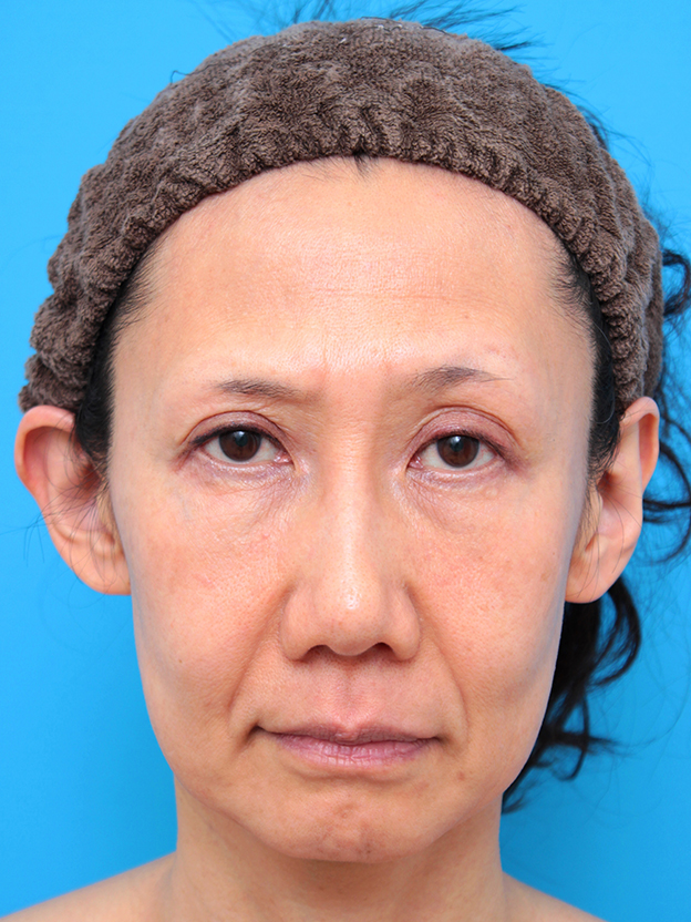 症例写真,40代女性のミディアムフェイスリフト症例写真,手術前,mainpic_mediumlift03a.jpg