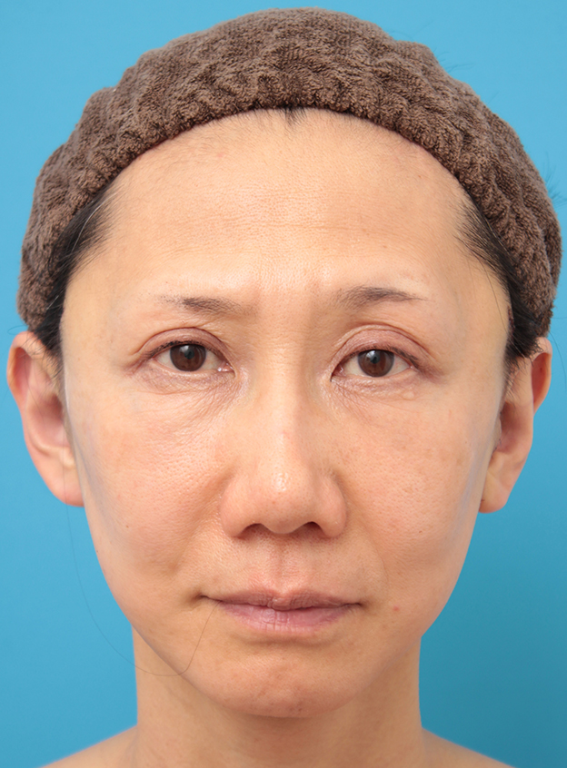 症例写真,40代女性のミディアムフェイスリフト症例写真,手術直後,mainpic_mediumlift03b.jpg