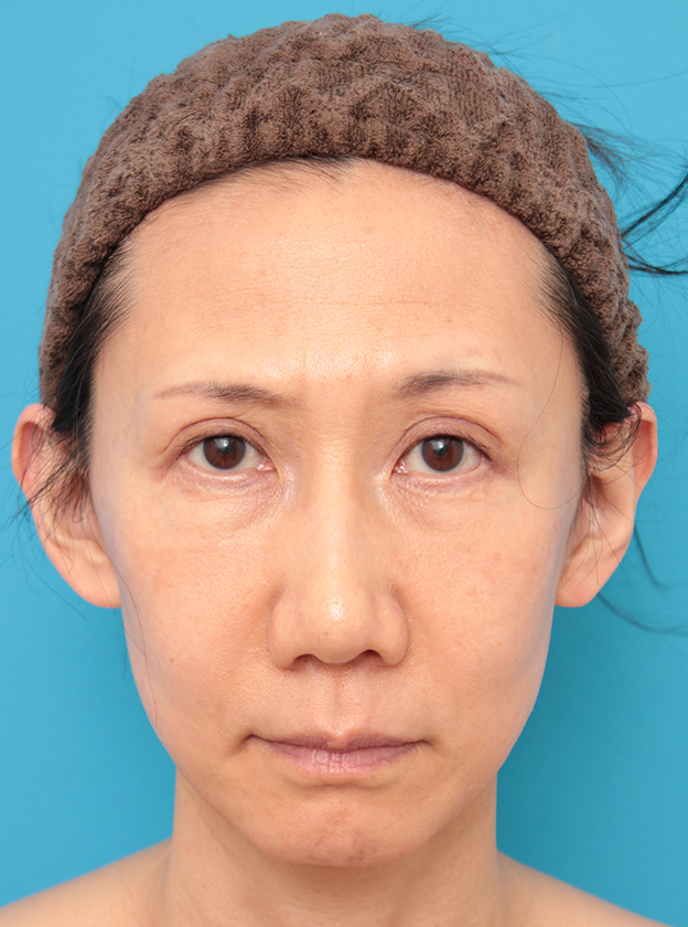 症例写真,40代女性のミディアムフェイスリフト症例写真,6ヶ月後,mainpic_mediumlift03c.jpg