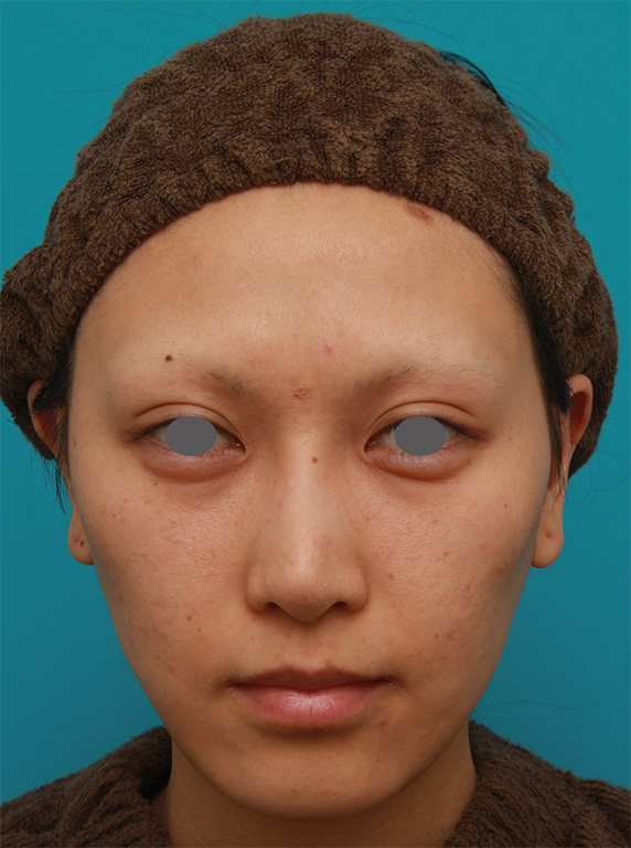 ミディアムフェイスリフトで頬のたるみをリフトアップさせた20代後半女性の症例写真の術前術後画像,After（4ヶ月後）,ba_mediumlift15_a01.jpg