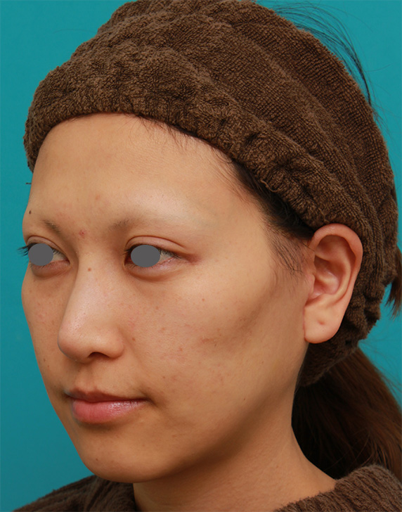 症例写真,ミディアムフェイスリフトで頬のたるみをリフトアップさせた20代後半女性の症例写真の術前術後画像,After（4ヶ月後）,ba_mediumlift16_b.jpg