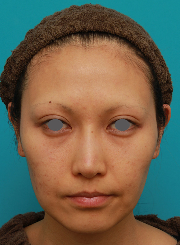 症例写真,ミディアムフェイスリフトで頬のたるみをリフトアップさせた20代後半女性の症例写真の術前術後画像,手術前,mainpic_mediumlift04a.jpg