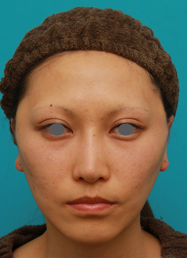 症例写真,ミディアムフェイスリフトで頬のたるみをリフトアップさせた20代後半女性の症例写真の術前術後画像,手術直後,mainpic_mediumlift04b.jpg