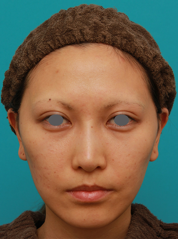 症例写真,ミディアムフェイスリフトで頬のたるみをリフトアップさせた20代後半女性の症例写真の術前術後画像,1週間後,mainpic_mediumlift04c.jpg