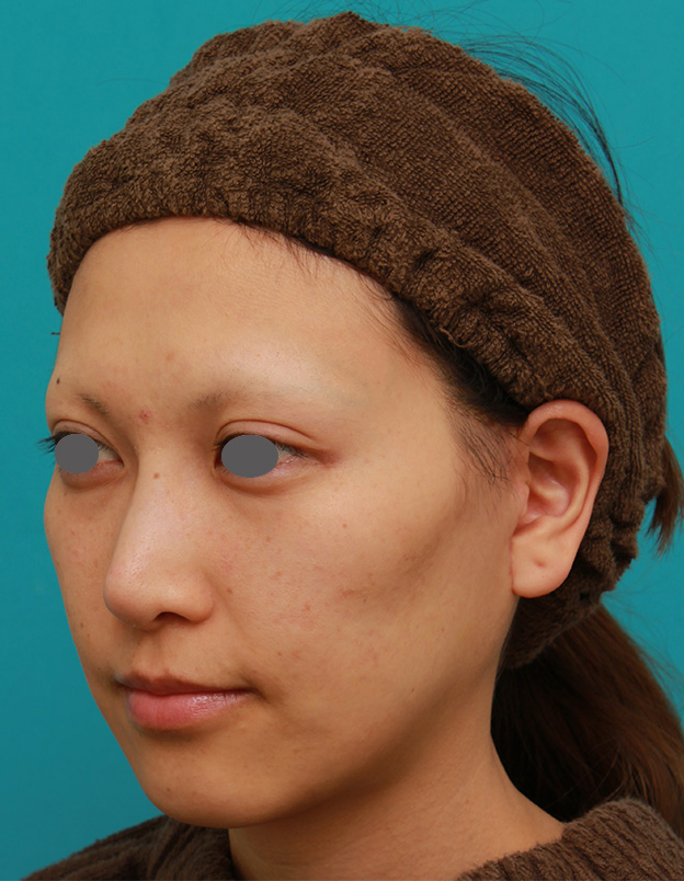 症例写真,ミディアムフェイスリフトで頬のたるみをリフトアップさせた20代後半女性の症例写真の術前術後画像,4ヶ月後,mainpic_mediumlift04h.jpg