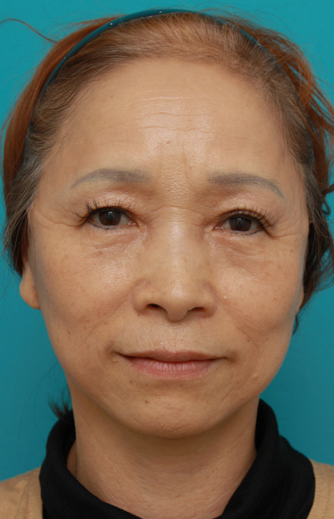 症例写真,60代女性に行ったミニフェイスリフト（頬のたるみ取り）症例写真,1ヶ月後,ba_minilift_pic15c.jpg