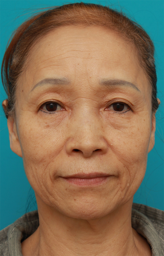 60代女性に行ったミニフェイスリフト（頬のたるみ取り）症例写真,Before,ba_minilift_pic17a_b.jpg