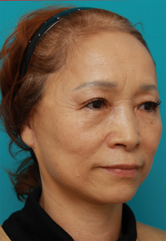 症例写真,60代女性に行ったミニフェイスリフト(頬のたるみ取り)症例写真,After(1ヶ月後),ba_minilift_pic17b_b.jpg