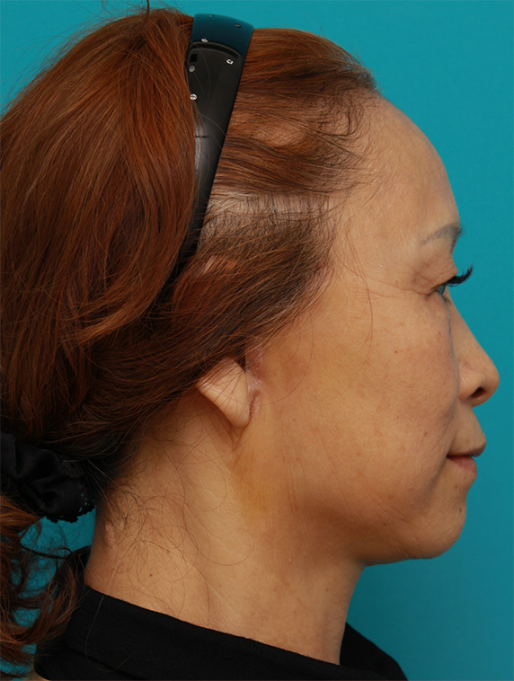 症例写真,60代女性に行ったミニフェイスリフト(頬のたるみ取り)症例写真,After(1ヶ月後),ba_minilift_pic17c_b.jpg