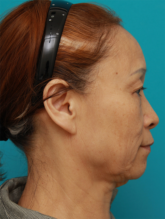 症例写真,60代女性に行ったミニフェイスリフト(頬のたるみ取り)症例写真,Before,ba_minilift_pic17c_b.jpg