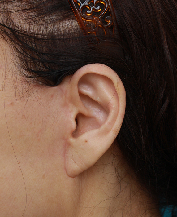 症例写真,60代女性に行ったミニフェイスリフト（頬のたるみ取り）症例写真,After（1ヶ月後）,ba_minilift_pic17d_b.jpg
