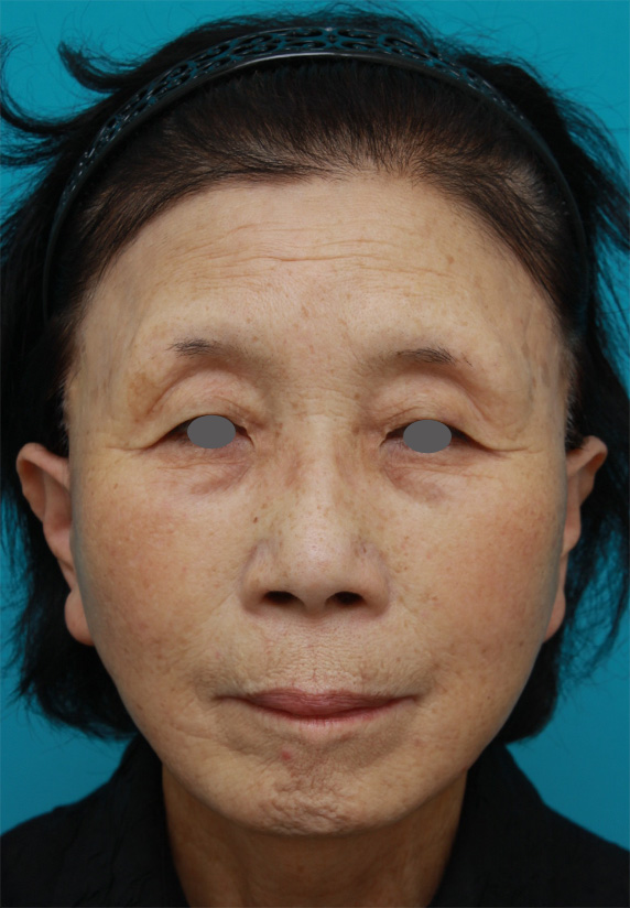 60代女性に行ったミニフェイスリフト（頬のたるみ取り）の症例写真,After,ba_minilift18_a01.jpg