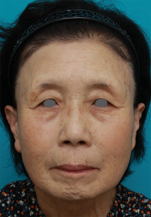 60代女性に行ったミニフェイスリフト（頬のたるみ取り）の症例写真,Before,ba_minilift18_b.jpg