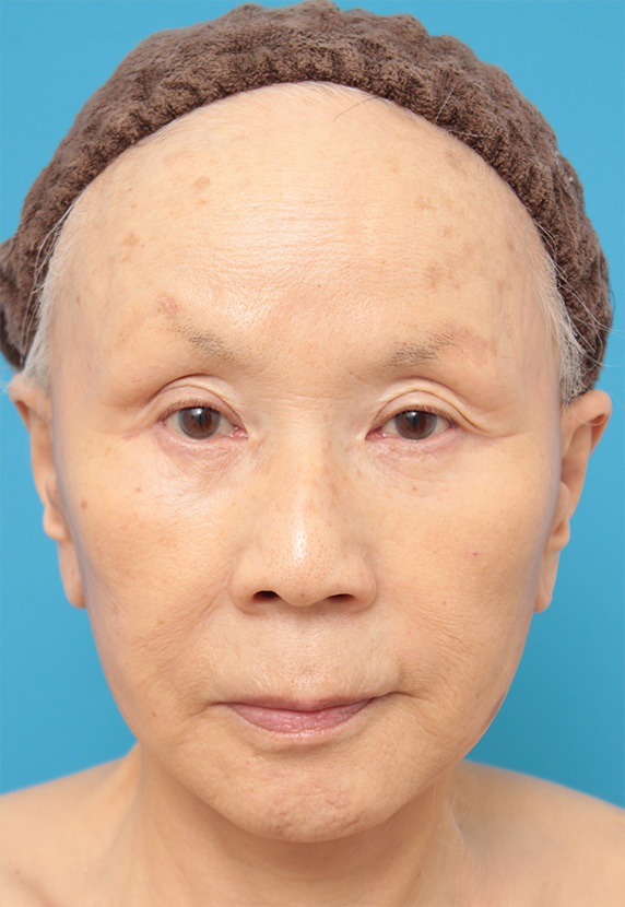 ミニフェイスリフト（頬のたるみ取り）,70代女性にミニフェイスリフト（頬のたるみ取り）を行った症例写真,After（6ヶ月後）,ba_minilift20_a01.jpg