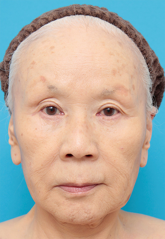 ミニフェイスリフト（頬のたるみ取り）,70代女性にミニフェイスリフト（頬のたるみ取り）を行った症例写真,Before,ba_minilift20_b.jpg