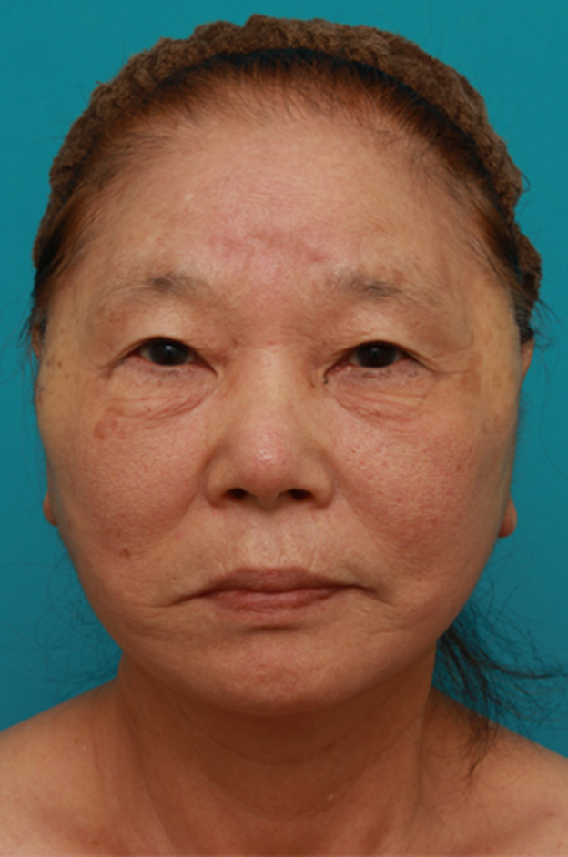 症例写真,70代女性にミニフェイスリフト（頬のたるみ取り）を行い、頬や首のたるみを改善させた症例　術前術後画像,手術直後,mainpic_minilift03b.jpg