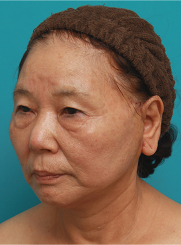 症例写真,70代女性にミニフェイスリフト（頬のたるみ取り）を行い、頬や首のたるみを改善させた症例　術前術後画像,1週間後,mainpic_minilift03g.jpg